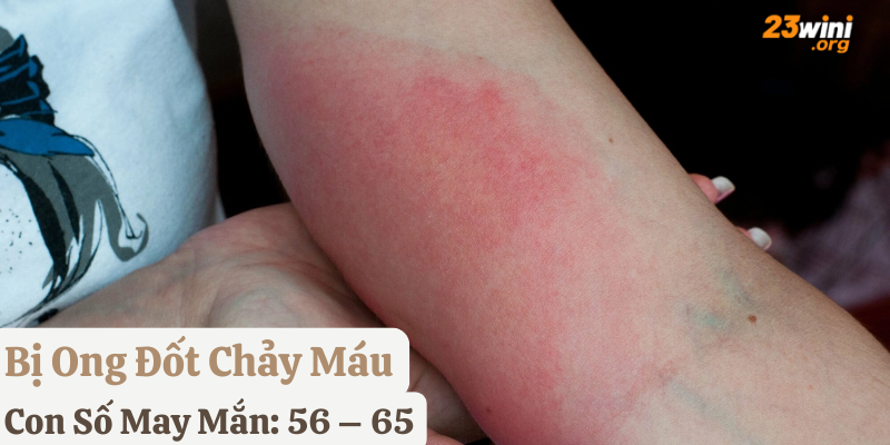 tự nhiên bị ong đốt